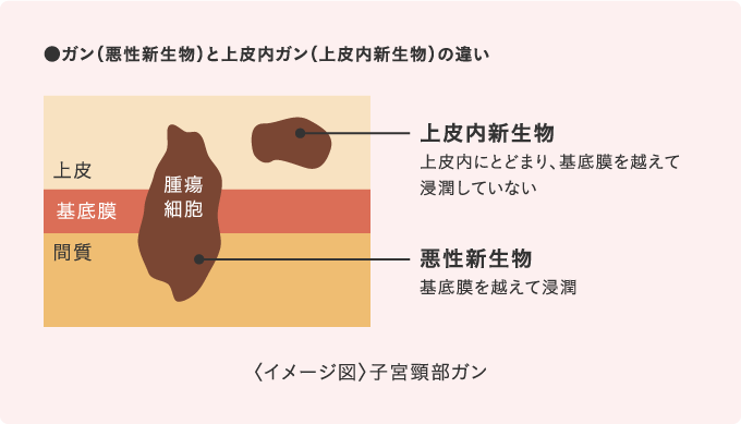 ガン（悪性新生物）と上皮内ガン（上皮内新生物）の違い 上皮内新生物 上皮内にとどまり、基底膜を越えて浸潤していない 悪性新生物 基底膜を越えて浸潤